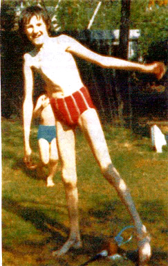 Young man displaying classical symptoms of Marfan syndrome